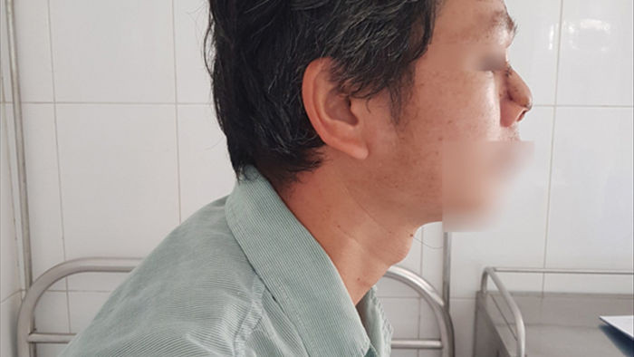 Người đàn ông Hà Nội phải cắt cụt mũi vì ung thư