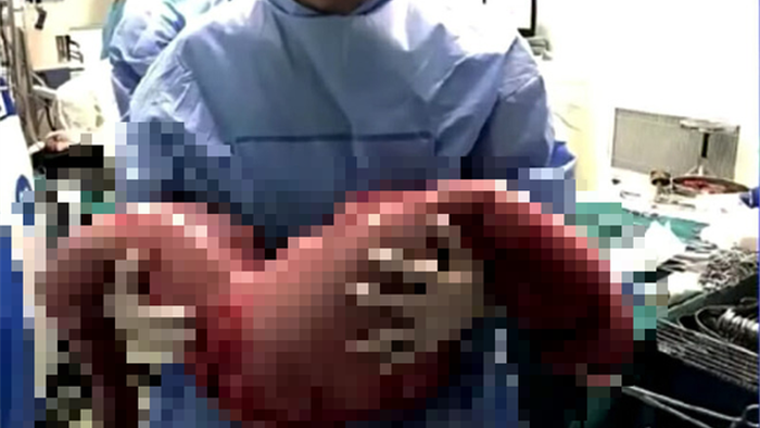 Bị táo bón bẩm sinh, anh chàng khiến các bác sĩ tá hỏa khi phẫu thuật cắt đoạn ruột chứa 13kg chất thải - Ảnh 1.