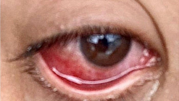Mắt đỏ có thể là dấu hiệu nhiễm virus corona - 2