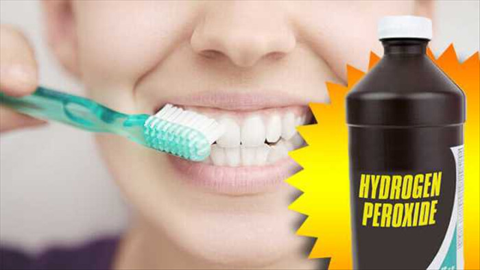 Học cách sử dụng hydrogen peroxide để làm trắng răng như trên Tik Tok: Chuyên gia khuyến cáo cần hết sức cẩn trọng! - Ảnh 1.