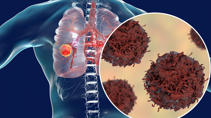 Ho dai dẳng và đau vùng lưng dưới: Nguy cơ ung thư phổi - 3