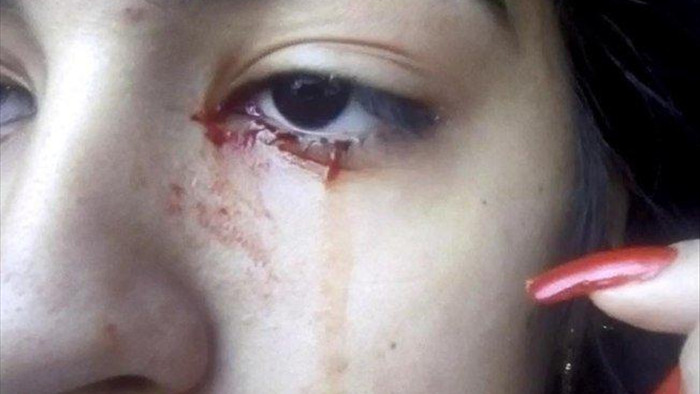 Bí ẩn tình trạng cô bé 15 tuổi liên tục khóc ra máu ở Brazil - 1