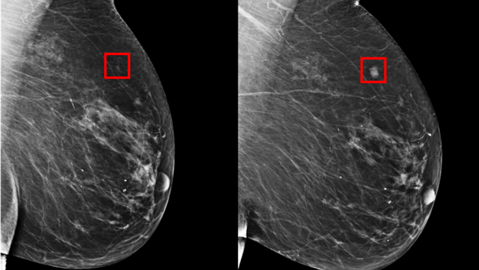 Đau lưng trên hoặc cổ: Dấu hiệu ít biết của bệnh ung thư vú - 1