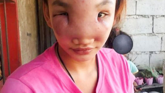 Cô gái xinh đẹp bị biến dạng khuôn mặt và mất thị lực sau một lần nặn mụn - 1