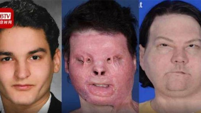 Khuôn mặt của Joe DiMeo trước khi bị tai nạn, sau khi bị tai nạn và sau khi được ghép mặt người khác (Ảnh: BTV).