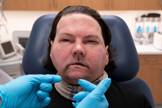 Người được phẫu thuật thay khuôn mặt thành công đầu tiên trên thế giới ảnh 1