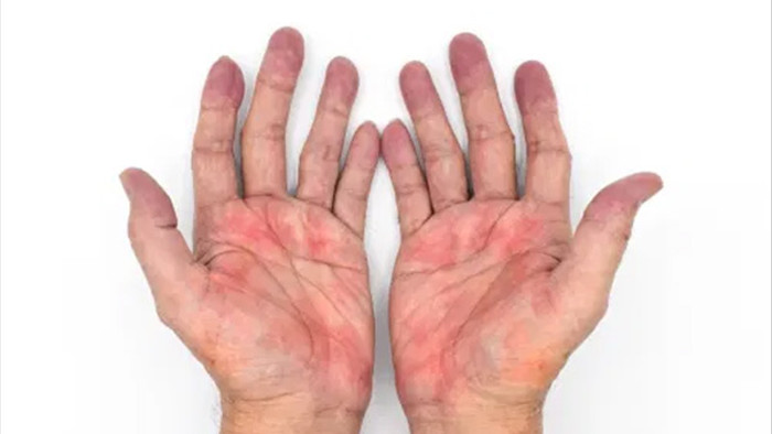 Dấu hiệu trên bàn tay cảnh báo bệnh gan