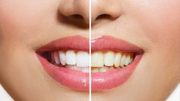 Nguyên nhân răng của bạn ngả màu vàng