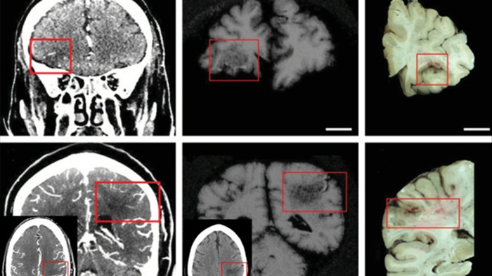 Nghiên cứu mới: Covid-19 ảnh hưởng nghiêm trọng tới não, dễ gây đột quỵ - 2