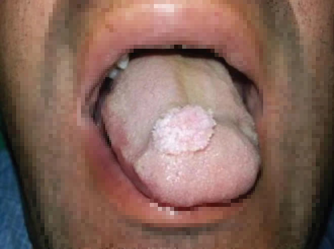 Ngày càng nhiều người trẻ thích quan hệ tình dục bằng miệng: BS mách nước 2 cách giảm nguy cơ lây nhiễm HPV và ung thư - Ảnh 3.