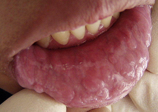 Ngày càng nhiều người trẻ thích quan hệ tình dục bằng miệng: BS mách nước 2 cách giảm nguy cơ lây nhiễm HPV và ung thư - Ảnh 4.