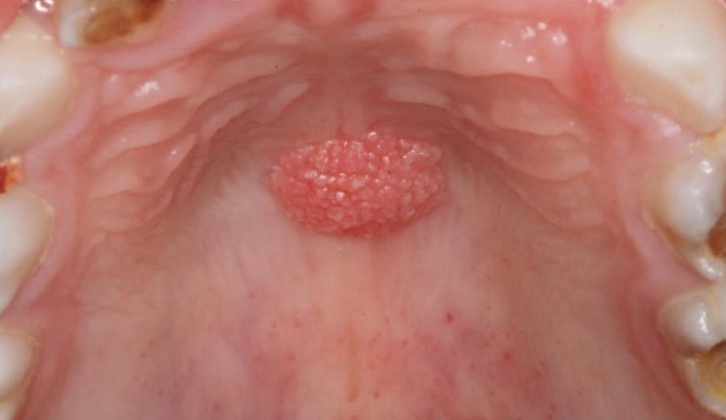 Ngày càng nhiều người trẻ thích quan hệ tình dục bằng miệng: BS mách nước 2 cách giảm nguy cơ lây nhiễm HPV và ung thư - Ảnh 6.