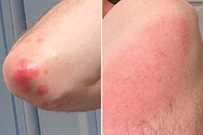 4 tác dụng phụ sau khi tiêm vaccine COVID-19 trên da hay gặp nhất: Có đáng lo ngại không? - Ảnh 2. 4 tác dụng phụ sau khi tiêm vaccine COVID-19 trên da hay gặp nhất: Có đáng lo ngại không?-2