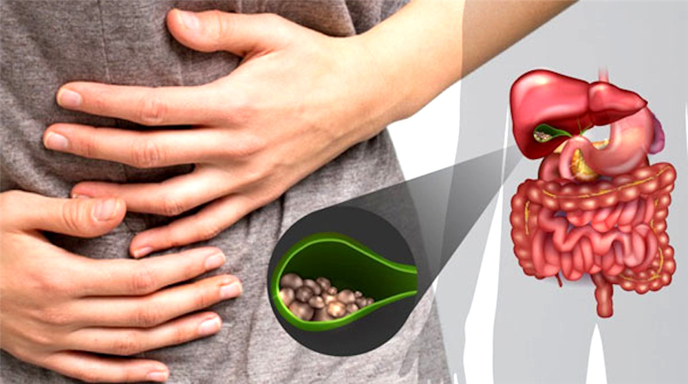 Triệu chứng sỏi mật: Rất dễ nhầm lẫn với bệnh dạ dày-1