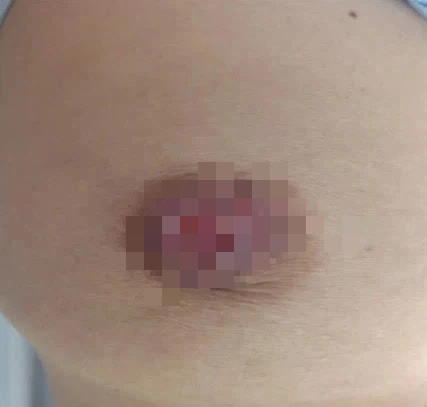 Phụ nữ có bộ ngực lớn, mô vú dày có thể đối mặt với nguy cơ ung thư vú - Ảnh 1. Phụ nữ có bộ ngực lớn, mô vú dày có thể đối mặt với nguy cơ ung thư vú - Ảnh 1.