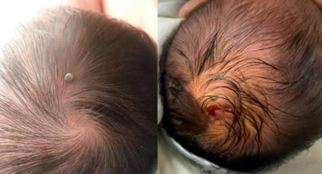 Bé sơ sinh 4 ngày tuổi bị ve chó cắn trên đầu, bố mẹ có một hành động được bác sĩ hết lời khen ngợi-1