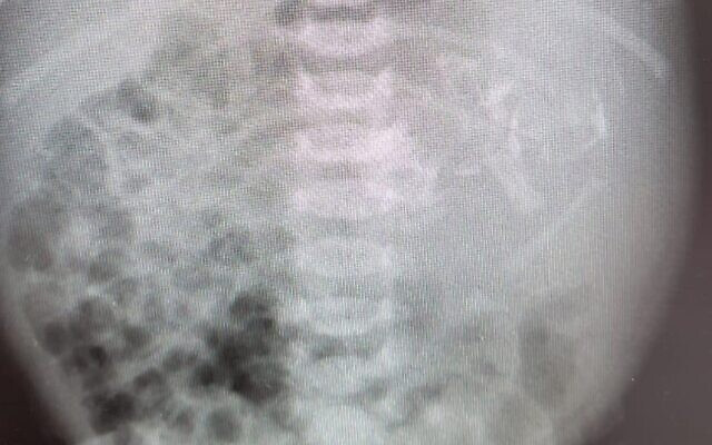 Bụng của bé sơ sinh to bất thường, bác sĩ kinh hoàng khi xem kết quả X-quang, lúc phẫu thuật lại càng choáng váng-1