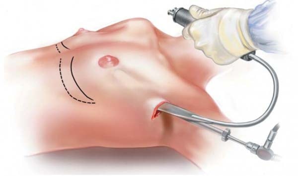 Túi nâng ngực - Những thông tin quý giá với phụ nữ có ý định “nâng cấp” vòng 1 - Ảnh 6. Túi nâng ngực - Những thông tin quý giá với phụ nữ có ý định “nâng cấp” vòng 1 - Ảnh 6.