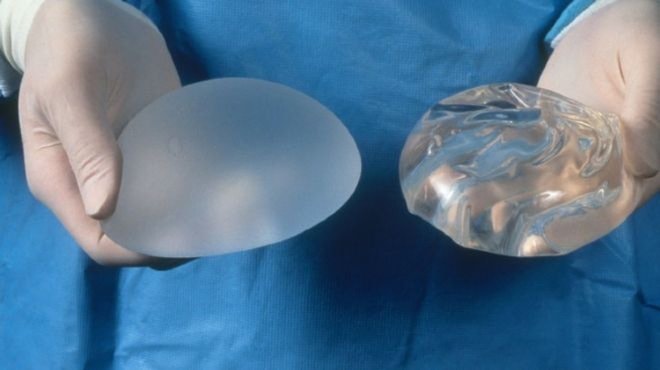 Túi nâng ngực - Những thông tin quý giá với phụ nữ có ý định “nâng cấp” vòng 1 - Ảnh 5. Túi nâng ngực - Những thông tin quý giá với phụ nữ có ý định “nâng cấp” vòng 1 - Ảnh 5.