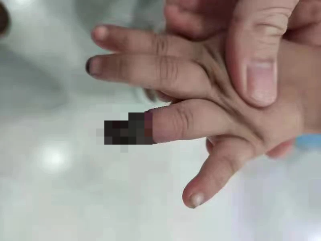 Cháu gái 3 tuổi bị hoại tử phải cắt ngón tay vì hành động sai lầm của bà, hình ảnh được chia sẻ khiến phụ huynh đau xót-1