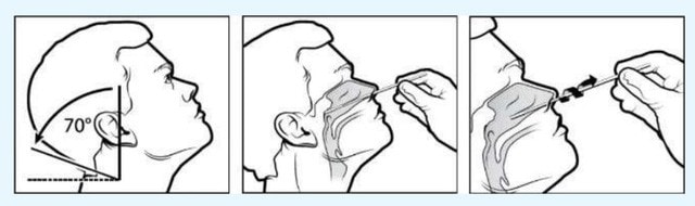 Hướng dẫn lấy mẫu, thực hiện test nhanh SARS-CoV-2 tại nhà - Ảnh 3. Hướng dẫn lấy mẫu, thực hiện test nhanh SARS-CoV-2 tại nhà - Ảnh 3.