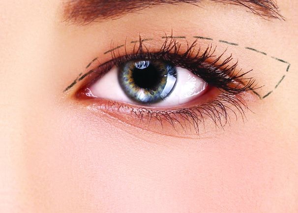 Phẫu thuật cắt mí: Lý do Phẫu thuật cắt mí: Lý do
