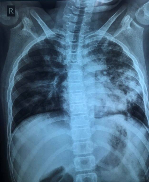 Trẻ 13 tuổi mắc Covid-19 tổn thương phổi nặng dù không có bệnh nền