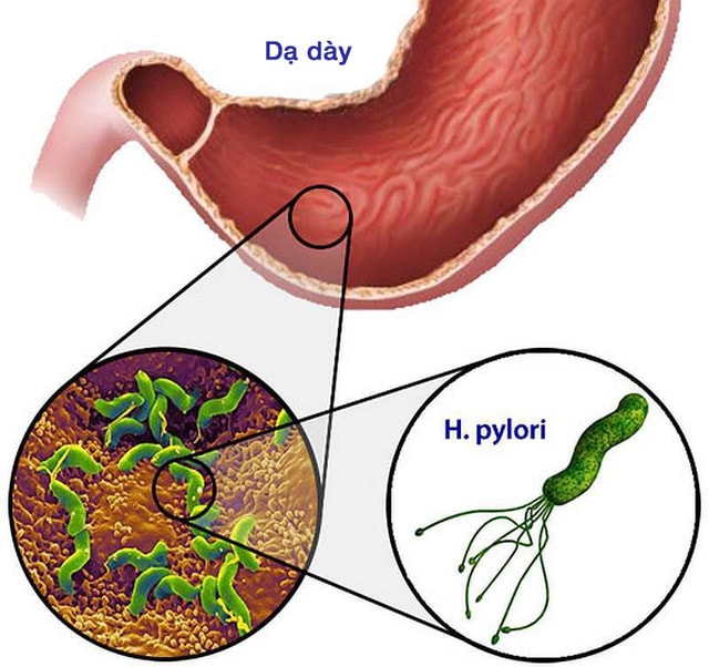 Nhiễm vi khuẩn Helicobacter pylori và nỗi lo ung thư dạ dày - Ảnh 1.