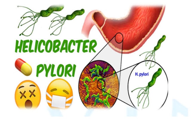 Nhiễm vi khuẩn Helicobacter pylori và nỗi lo ung thư dạ dày - Ảnh 2.