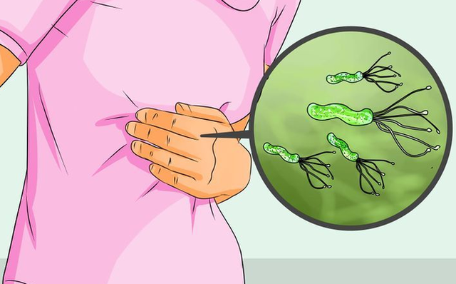 Nhiễm vi khuẩn Helicobacter pylori và nỗi lo ung thư dạ dày - Ảnh 3.