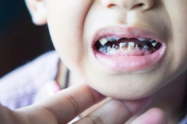 Quan niệm ăn kẹo gây sâu răng” lẽ ra phải thay đổi từ lâu! Bé bị sâu răng vì làm sai 3 điều này-1