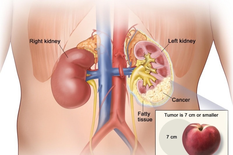 Những dấu hiệu phổ biến nhất của ung thư thận - 1