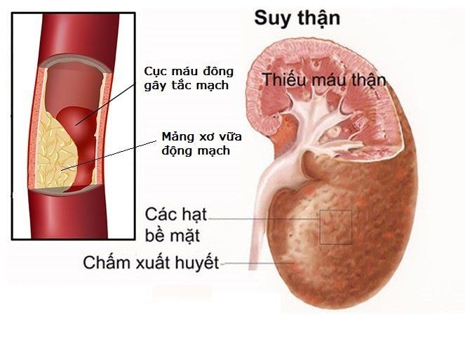 10 cách phòng ngừa suy thận không phải ai cũng biết