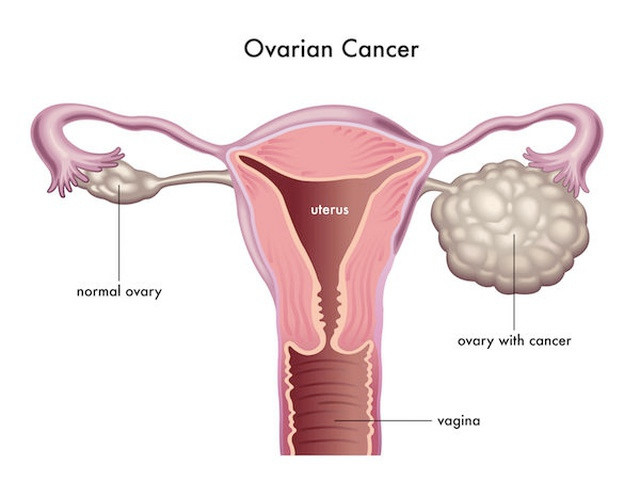 Tỷ lệ tái phát của ung thư buồng trứng - 1