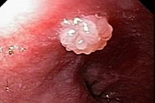 Cứ nhiễm HPV là có nguy cơ ung thư? - 1 Cứ nhiễm HPV là có nguy cơ ung thư? - 1