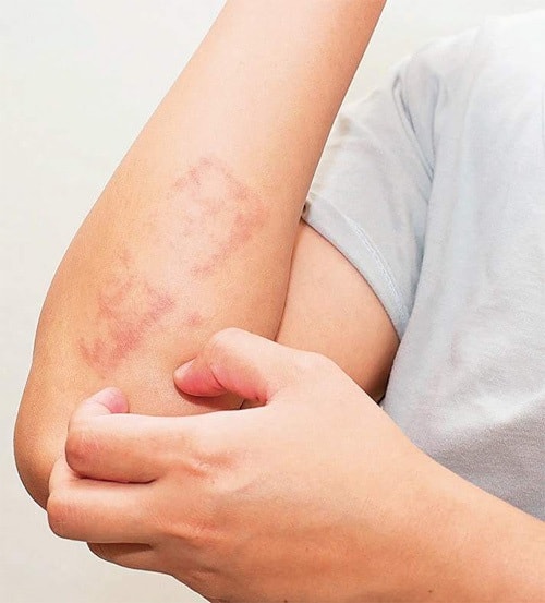 Bệnh vẩy nến làm tăng nguy cơ ung thư? - 1 Bệnh vẩy nến làm tăng nguy cơ ung thư? - 1