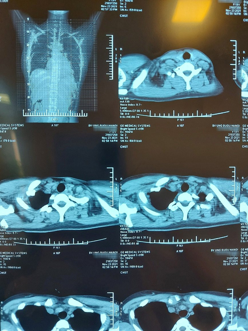 Cô gái 19 tuổi ở Hà Nội bị khối u quái to 20cm đè bẹp phổi - 1