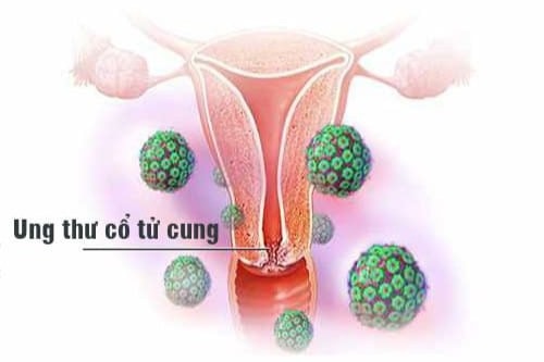 Ung thư cổ tử cung có thể phát hiện sớm không? - 1 Ung thư cổ tử cung có thể phát hiện sớm không? - 1