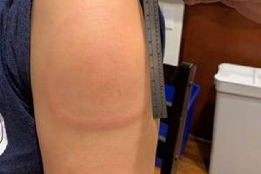 Phản vệ sau tiêm vaccine COVID-19, làm sao để giảm rủi ro? - Ảnh 1. Phản vệ sau tiêm vaccine COVID-19, làm sao để giảm rủi ro? - Ảnh 1.