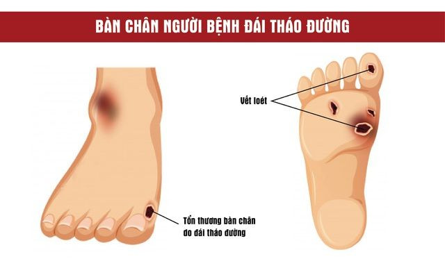 7 sai lầm khi điều trị đái tháo đường