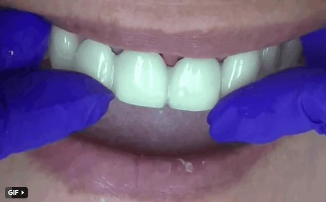 Nghệ sĩ bọc răng sứ: Đẹp và nhanh thật nhưng phải cân nhắc kĩ-6