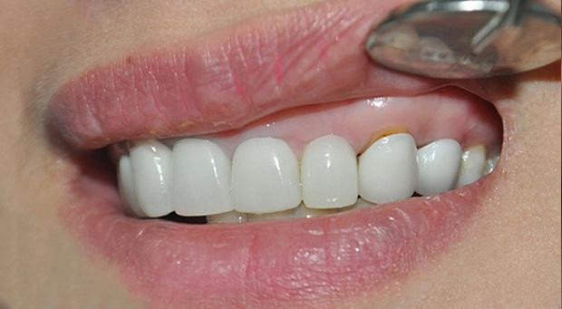 Nghệ sĩ bọc răng sứ: Đẹp và nhanh thật nhưng phải cân nhắc kĩ-8