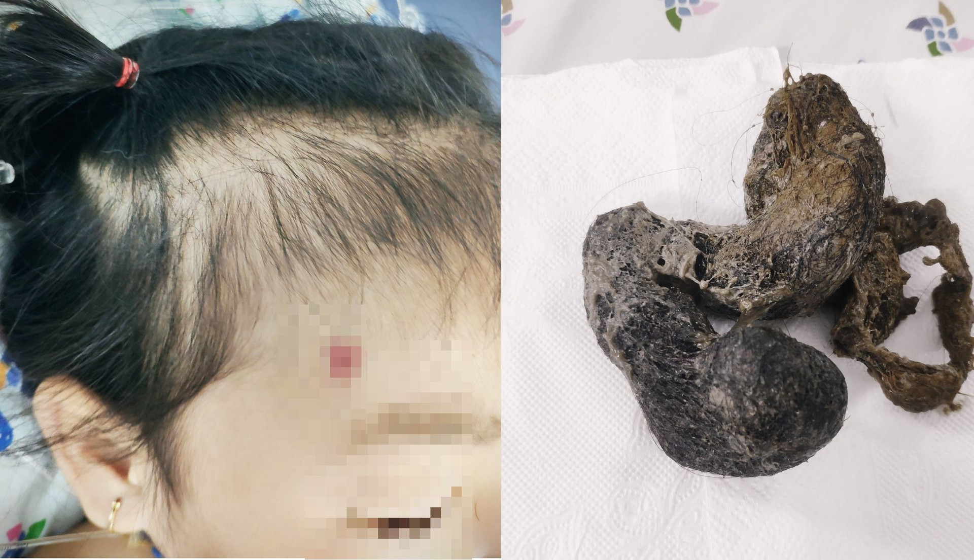 Bé gái 4 tuổi cấp cứu vì hội chứng 'cô bé tóc mây' hiếm gặp