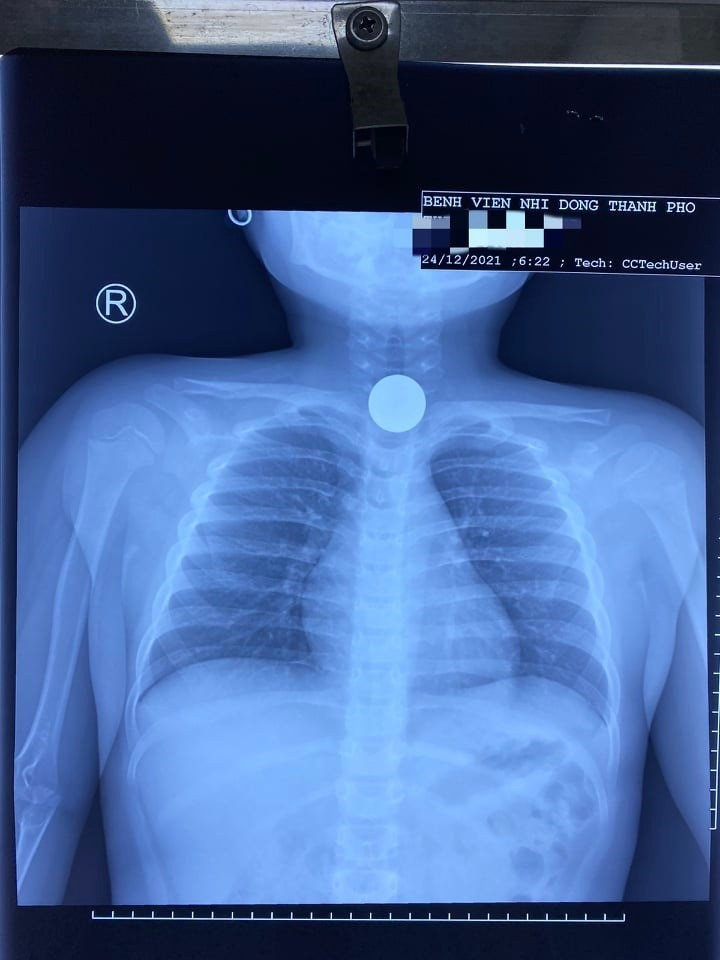Hình chụp X-quang của bệnh nhi khi có dị vật trong cơ thể. Ảnh: BVCC