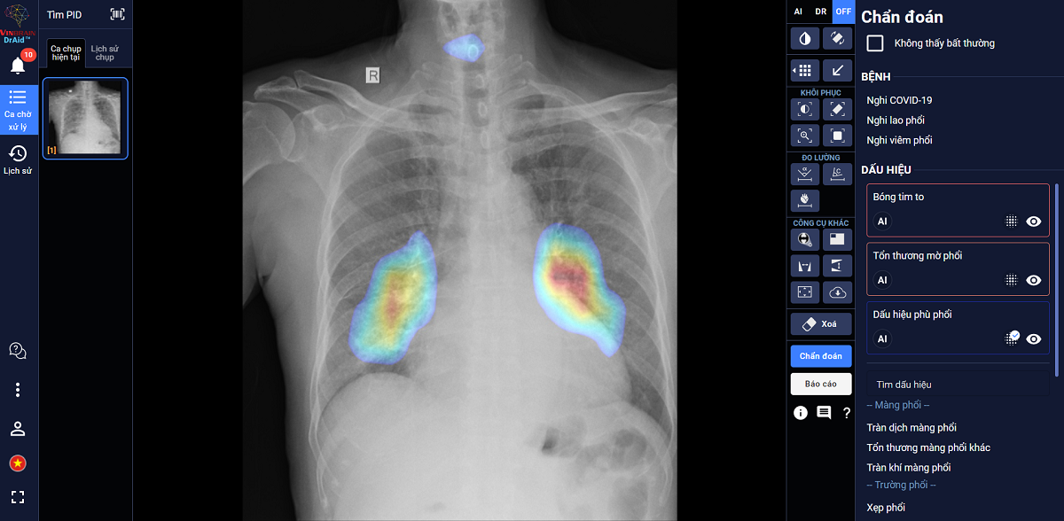 DrAid có thể hỗ trợ chẩn đoán tới tiên lượng điều trị COVID 19 dựa trên ảnh X-quang ngực thẳng.