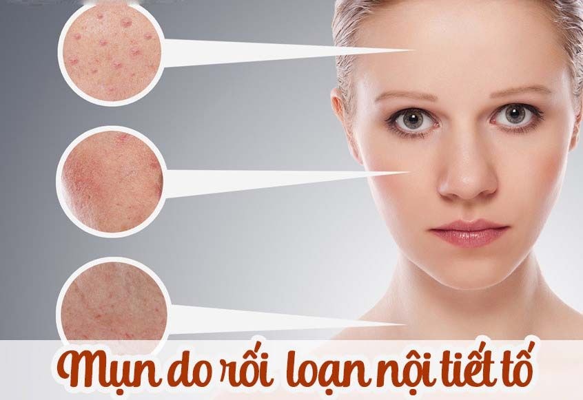 Nổi mụn do nội tiết tố? Đặc điểm và cách điều trị tận gốc