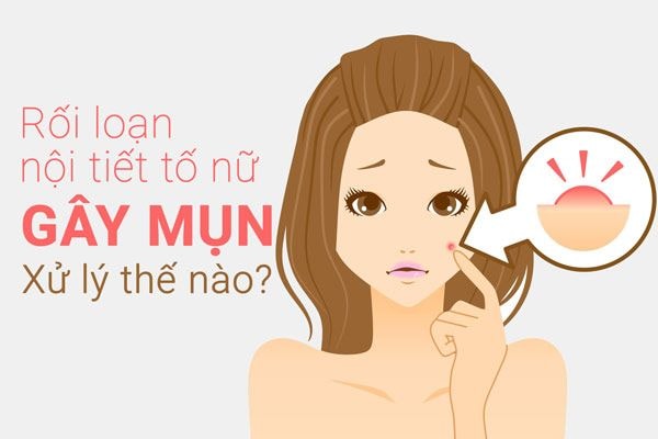 Nổi mụn do nội tiết tố? Đặc điểm và cách điều trị tận gốc