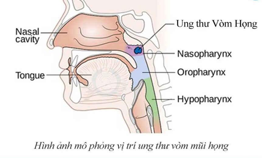 Nội soi có phát hiện được ung thư vòm họng? - 1