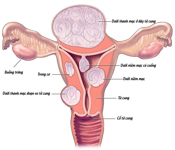 U xơ tử cung có thể gây ra triệu chứng gì? - 1