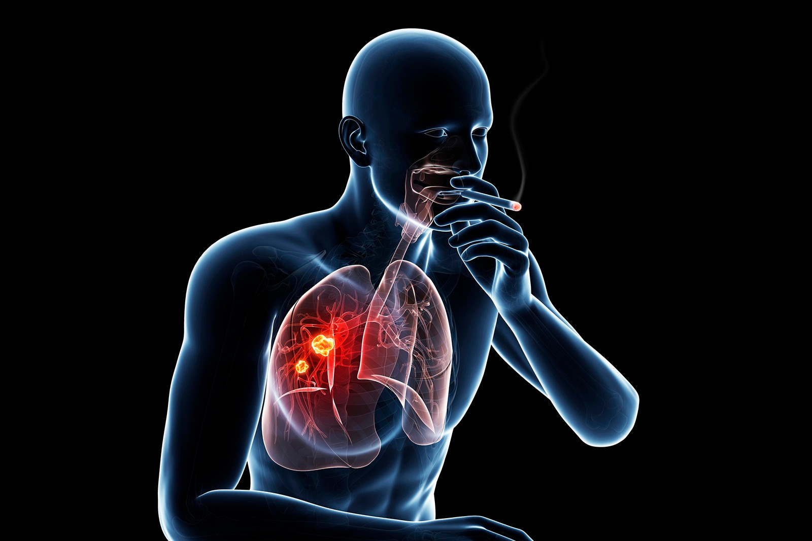 Ung thư phổi: Các tác dụng phụ hay gặp khi điều trị đích - 1